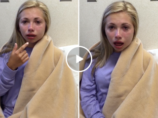 Girl thinks she has no bottom lip after wisdom teeth surgery (Video)