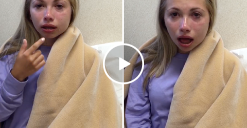 Girl thinks she has no bottom lip after wisdom teeth surgery (Video)